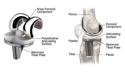 High Flex Knee Replacement Surgery in India