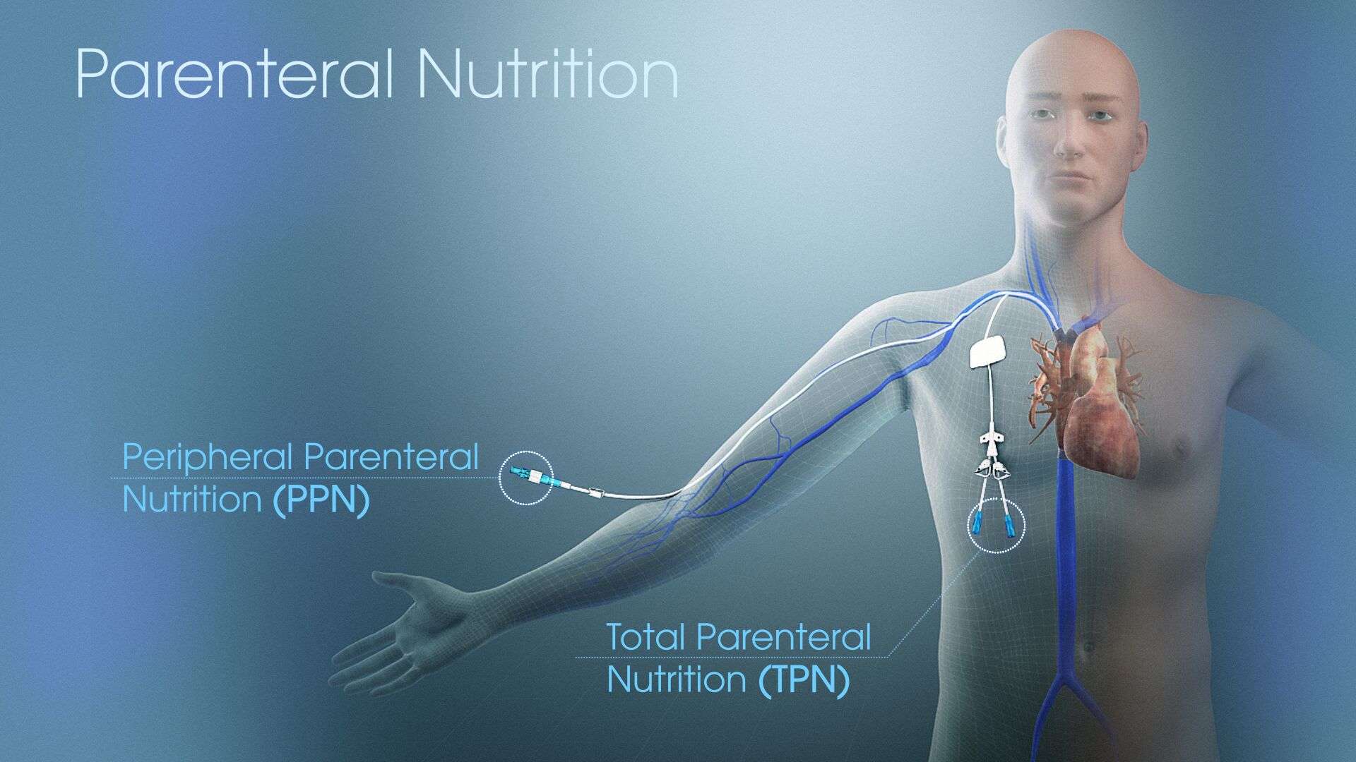 Parenteral Nutrition Market Trends, Share and Future Growth 2030