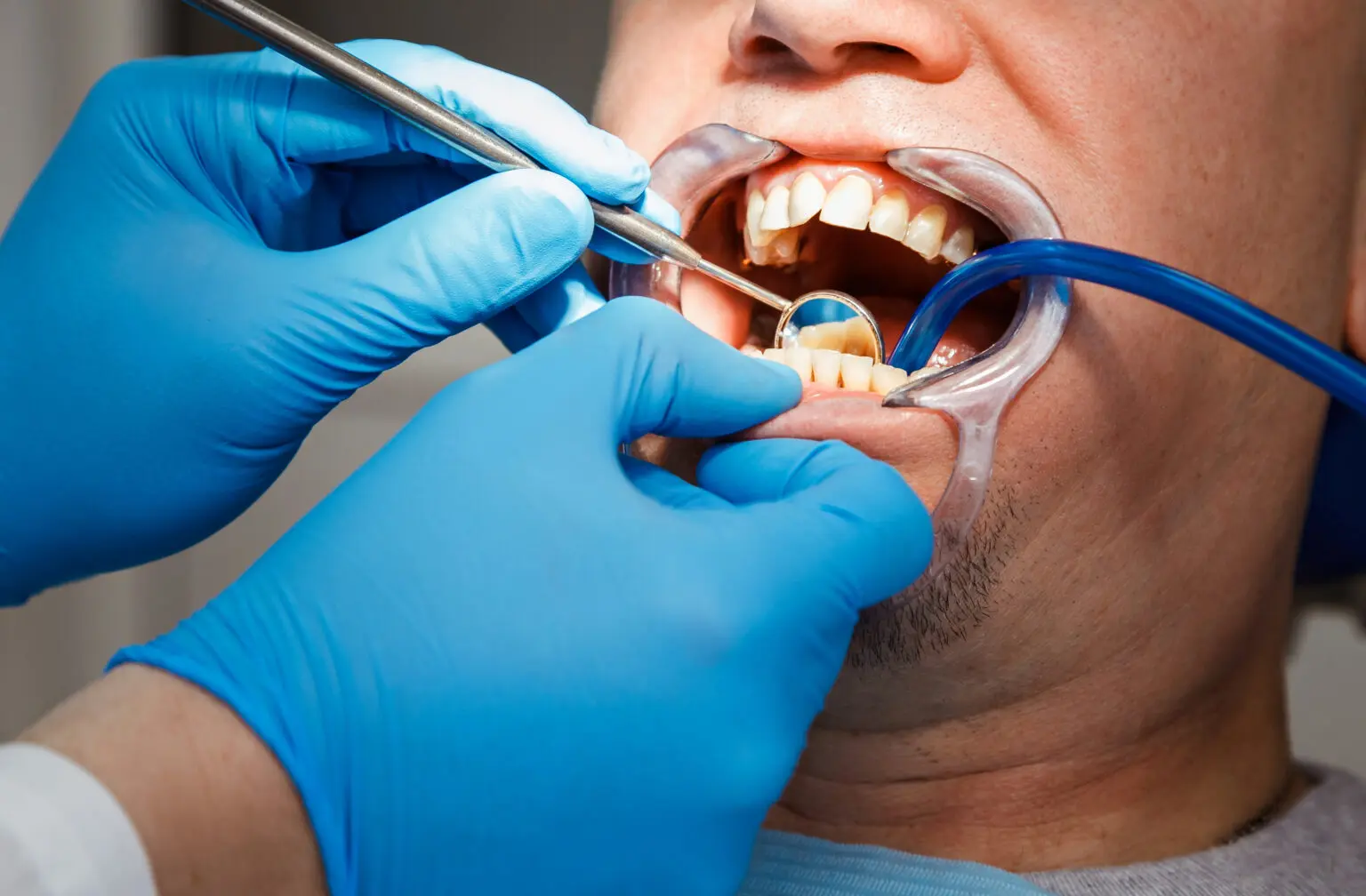 Addressing Common Dental Problems with Tooth-Colored Fillings