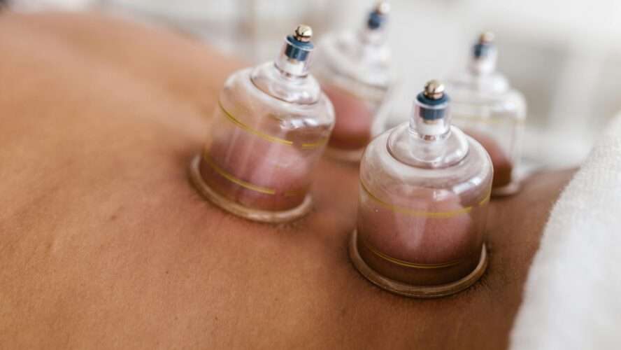 Hijama: An Ancient Practice with Modern Appeal