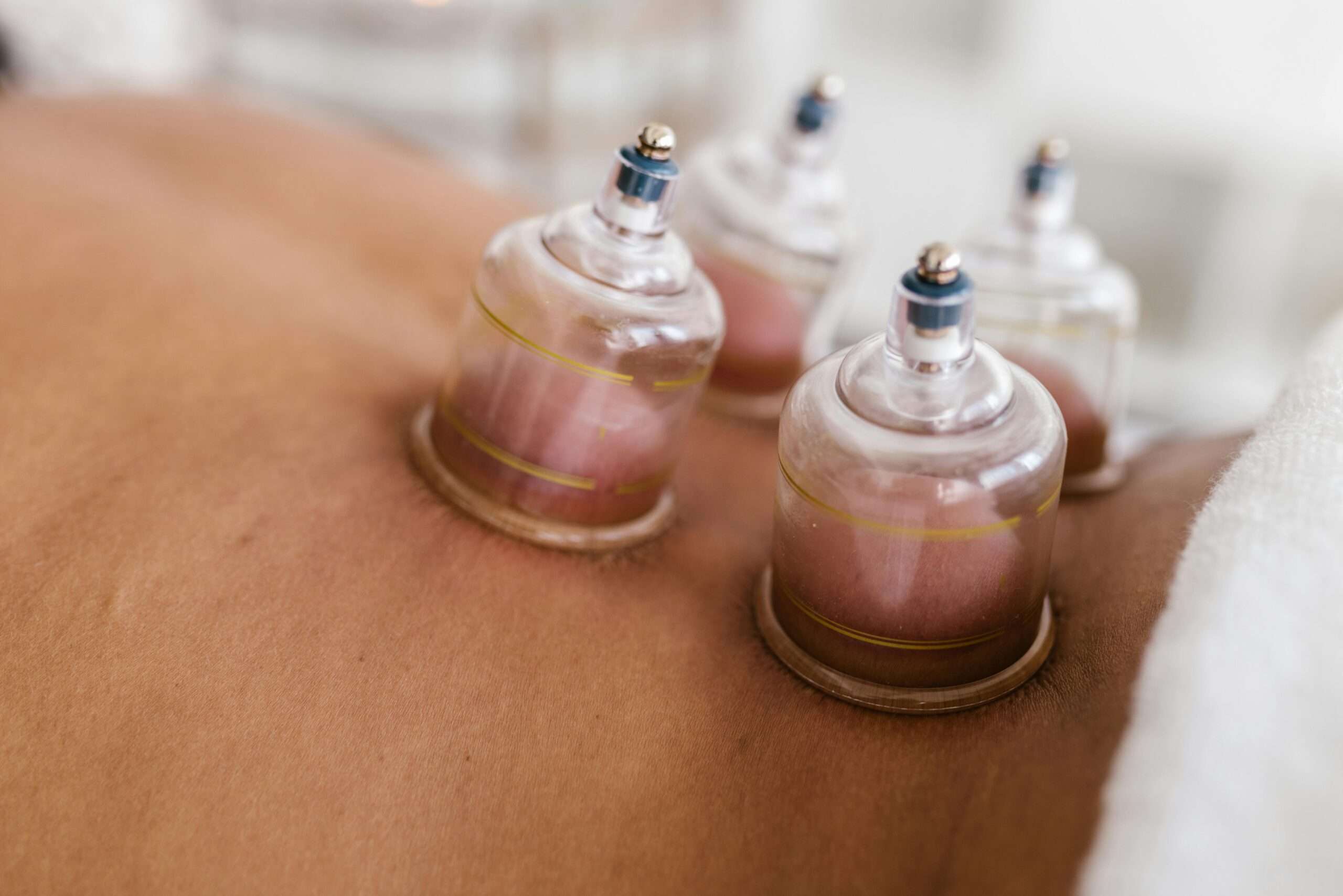 Hijama: An Ancient Practice with Modern Appeal