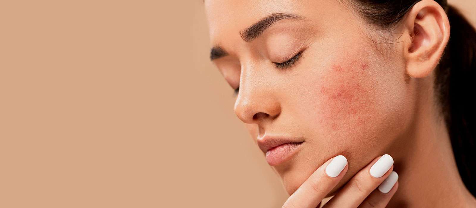 Acne Treatment Vienna | Customized Skincare for Clear Skin