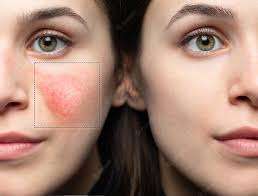 BBL Laser treatment for patients having rosacea