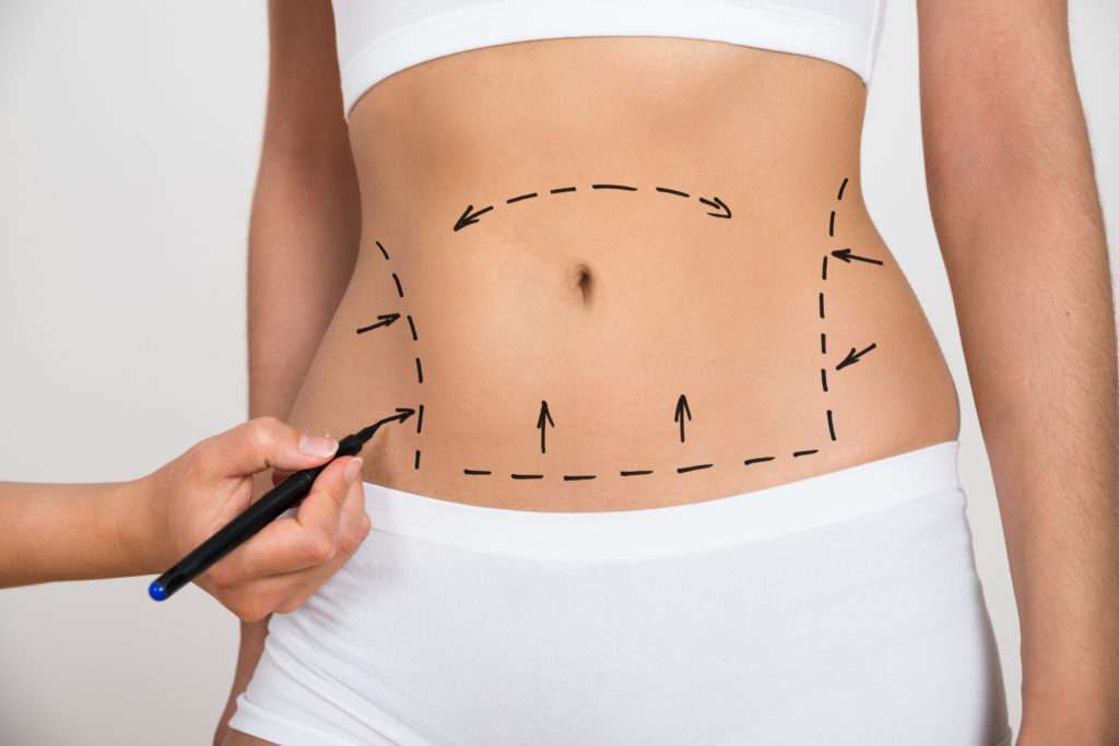 What Should I Expect During a Liposuction Consultation