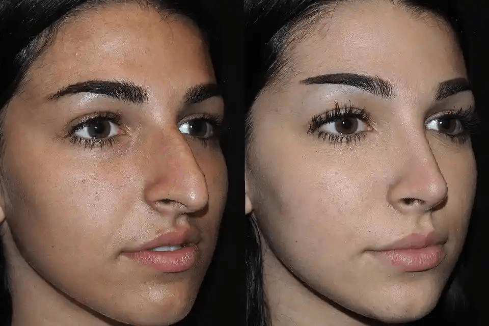 Rhinoplasty in Dubai: Balance Your Face