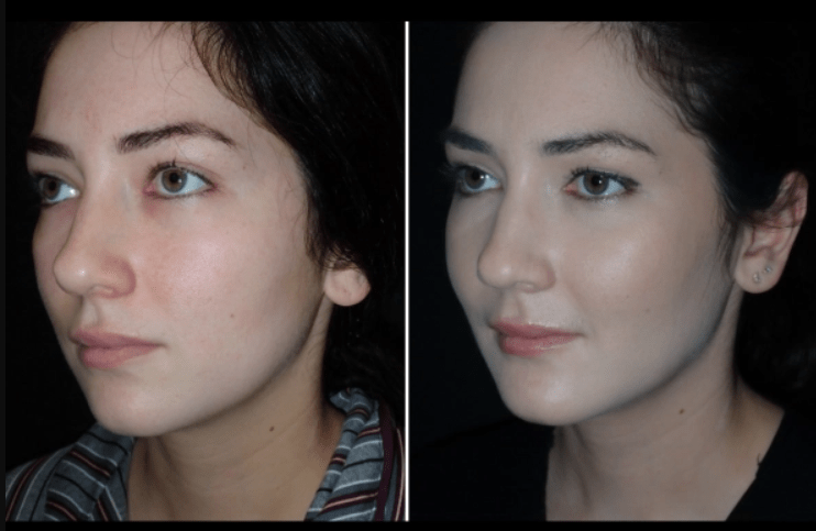 Facial Fat Transfer in Dubai for Volume Restoration What to Expect