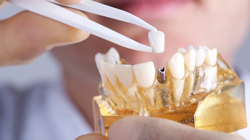 How long do dental implants typically last?