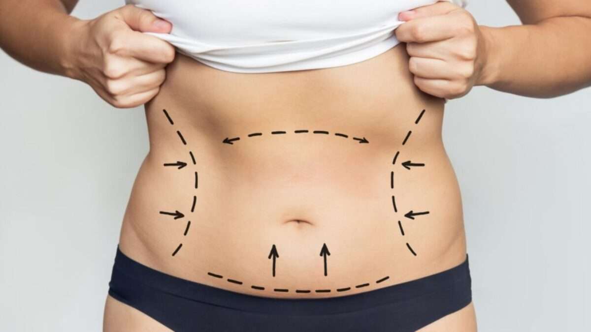 Can Liposuction in Dubai Be Done on the Face