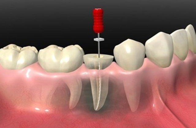 The Root Canal Market Growth Analysis by 2031