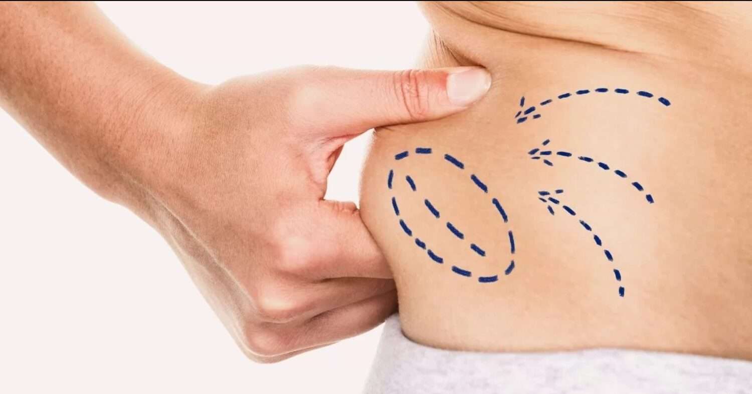 Stomach Liposuction in Dubai Preparing Your Family for Your Recovery Journey