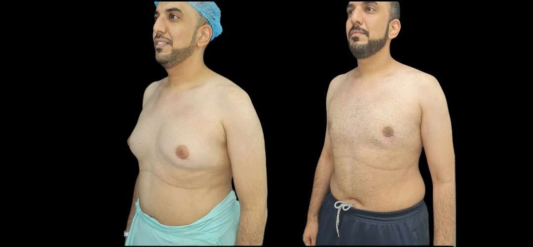 Top Benefits of Gynecomastia Surgery: Expert Insights from the Best Doctors in Dubai