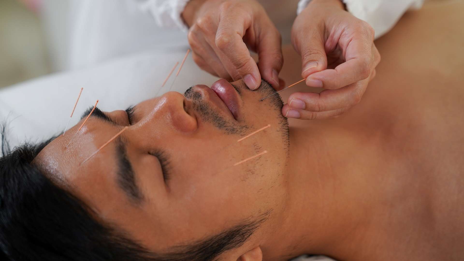 Facial Acupuncture in Philadelphia: A Natural Beauty Boost