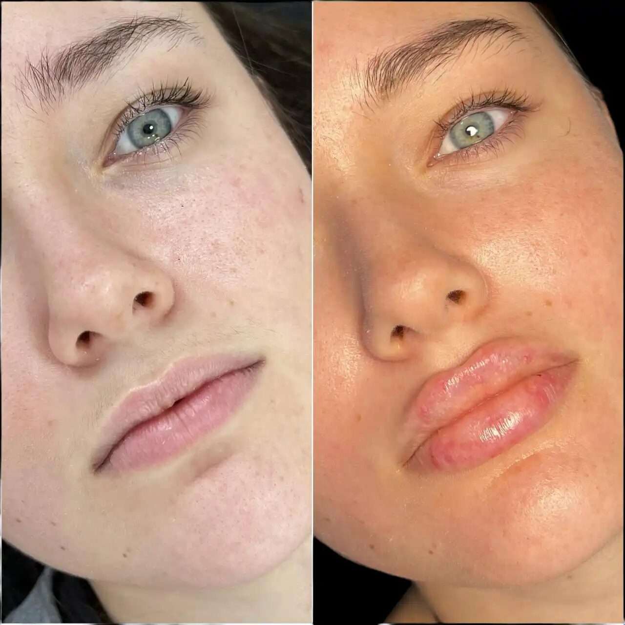 The Rising Popularity of Juvederm treatment in Dubai Among Millennials