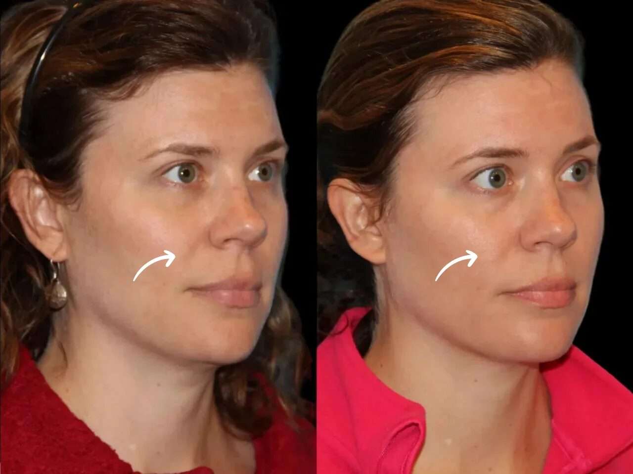 Sculptra for Full-Face Rejuvenation: A Guide by the Best Doctors in dubai