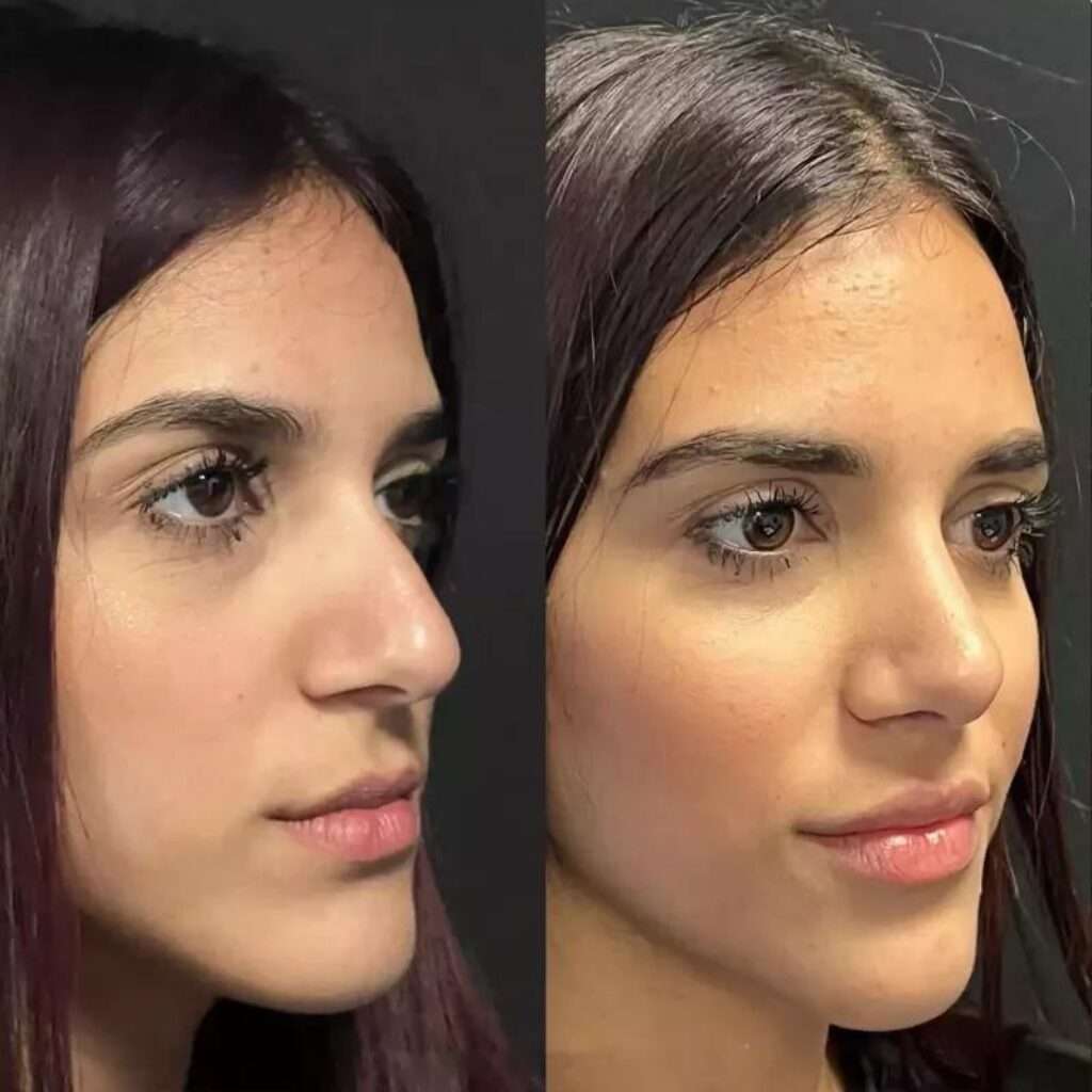 Rhinoplasty in Dubai: Everything You Need to Know About Nose Reshaping