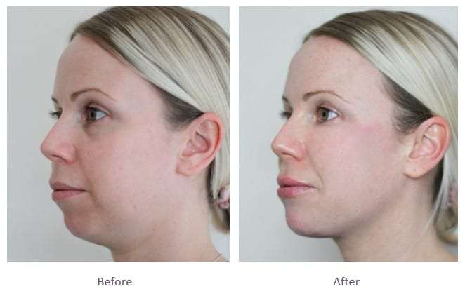 Jawline Fillers Treatments in Dubai: Enhance Your Facial Proportions