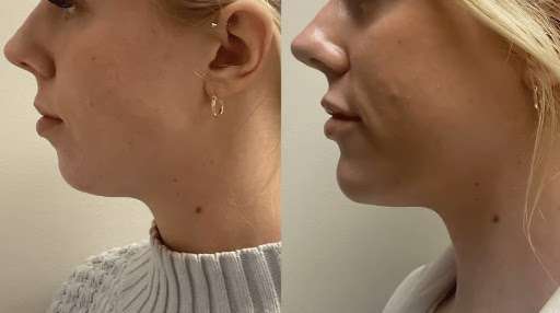 Chin Fillers Treatments in Dubai: Non-Surgical Solution for a Refined Profile