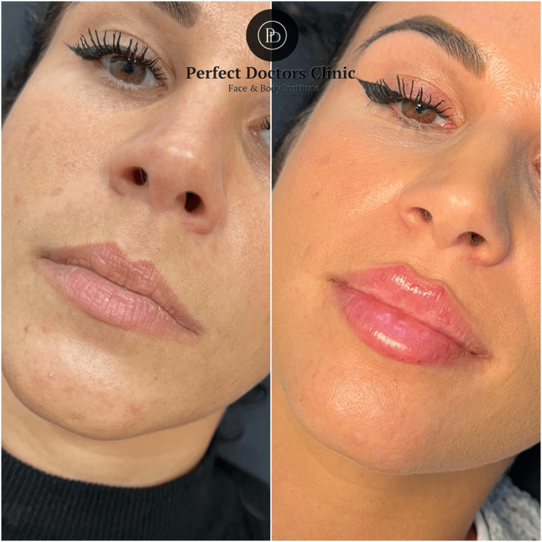 Juvederm to Restore Facial Volume: Best Doctors in dubai