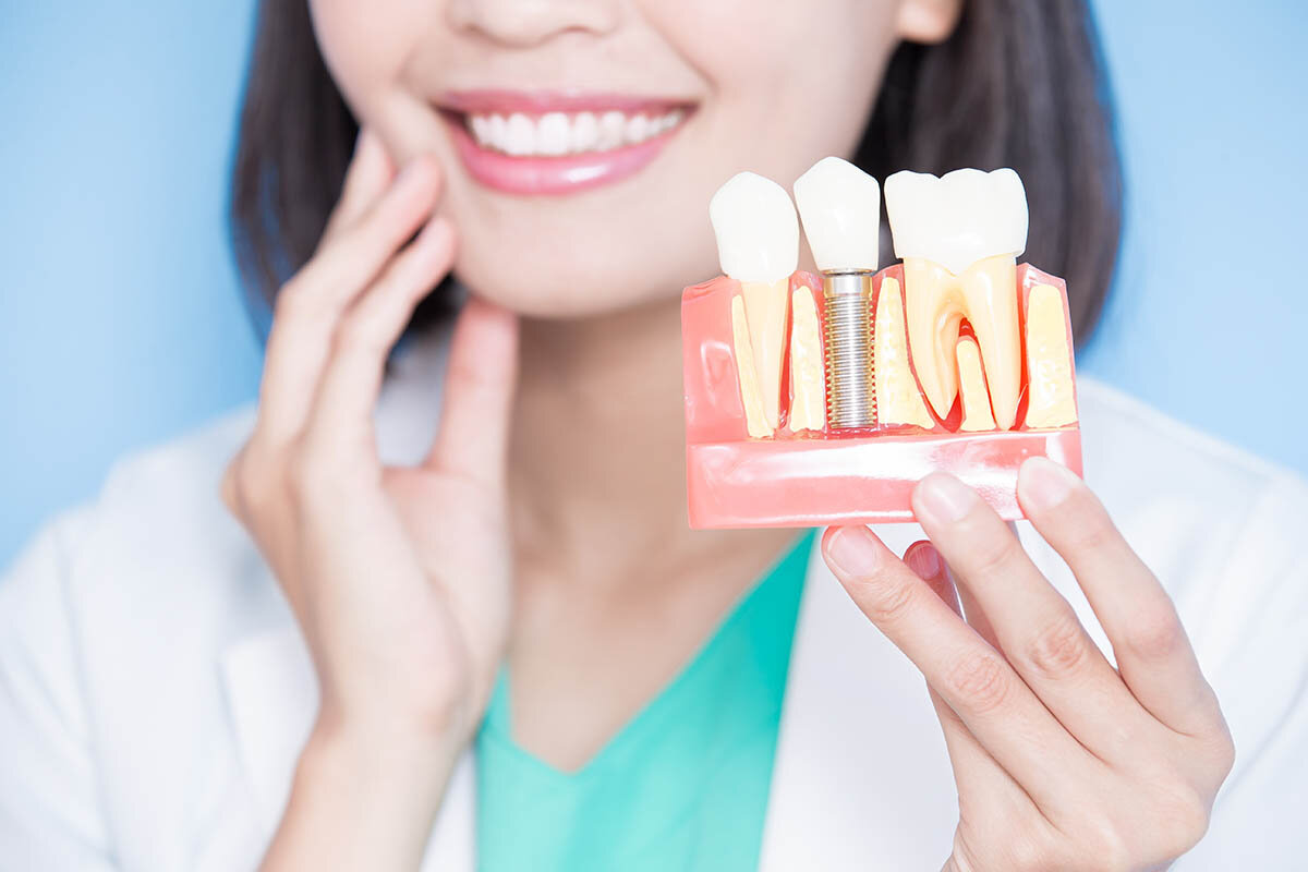 How Long Can Tooth Replacements Typically Last?