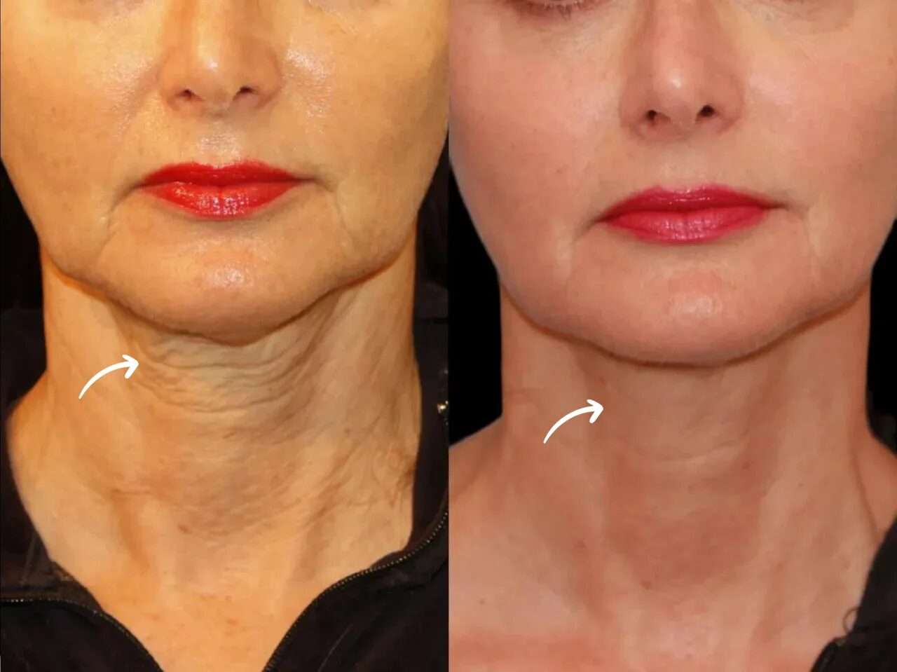 Enhancing Skin Elasticity with Sculptra Fillers Treatment in Dubai