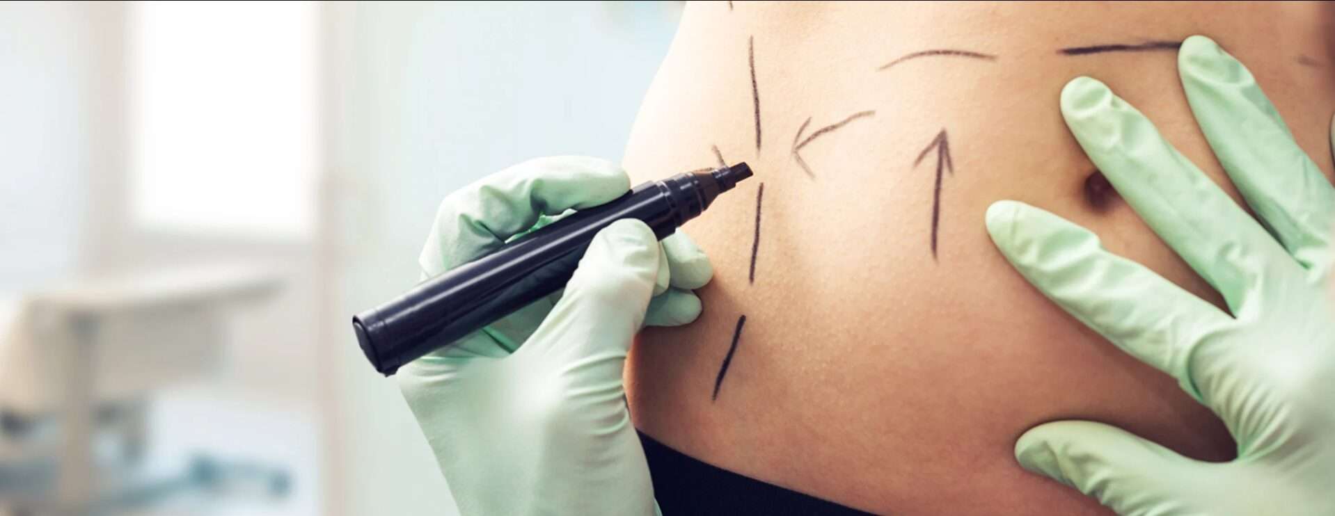 Unexpected Scenarios in Full Body Liposuction in Dubai Approach