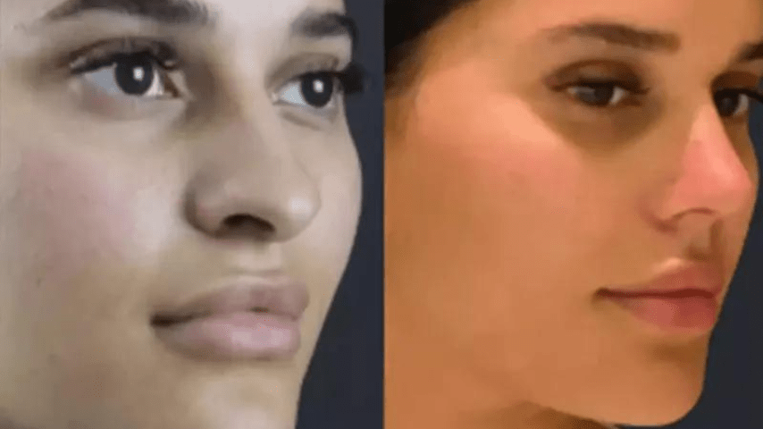 Rhinoplasty in Dubai: Your Complete Guide to Achieving the Perfect Nose