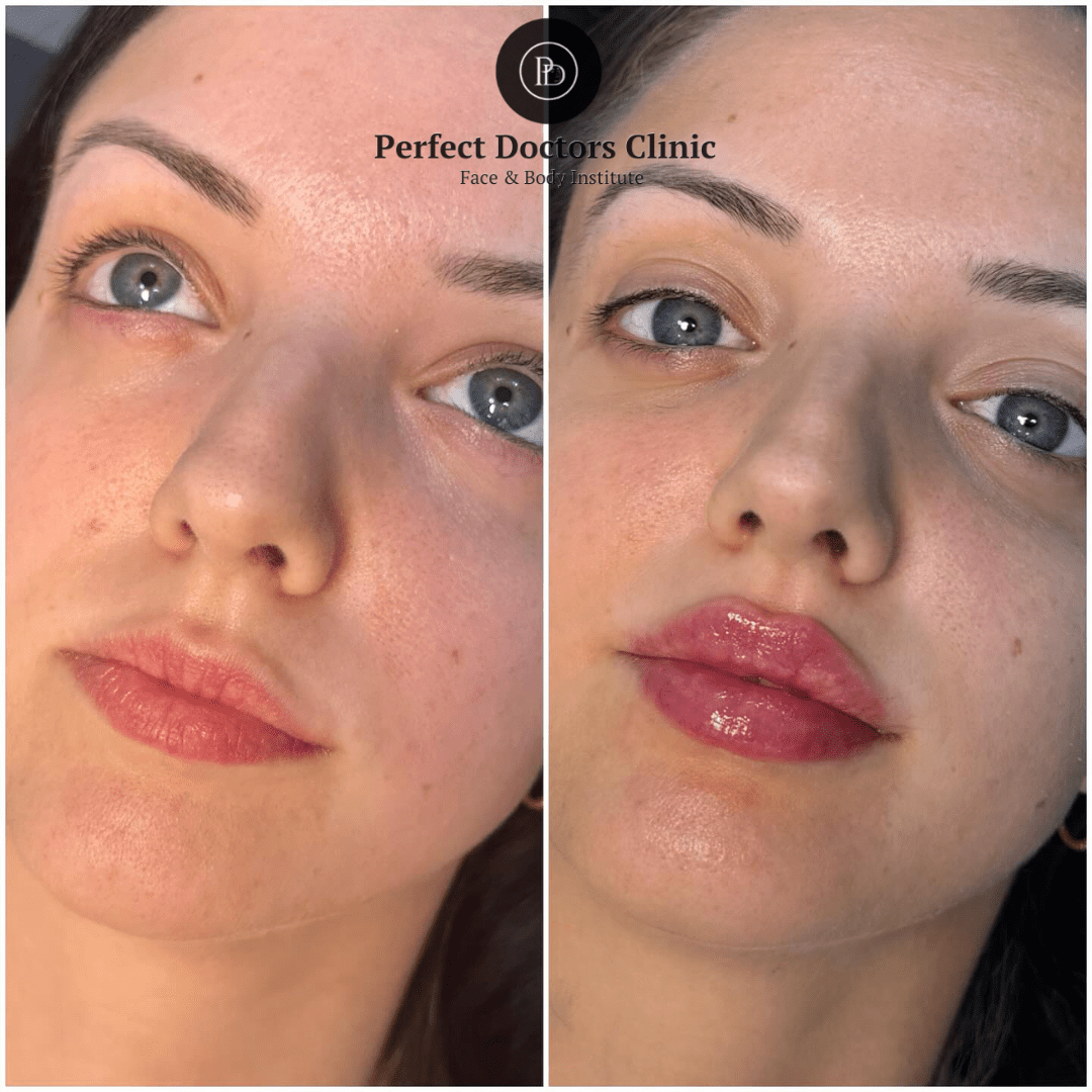 Juvederm for Non-Surgical Face Lifts: Best Doctors in dubai