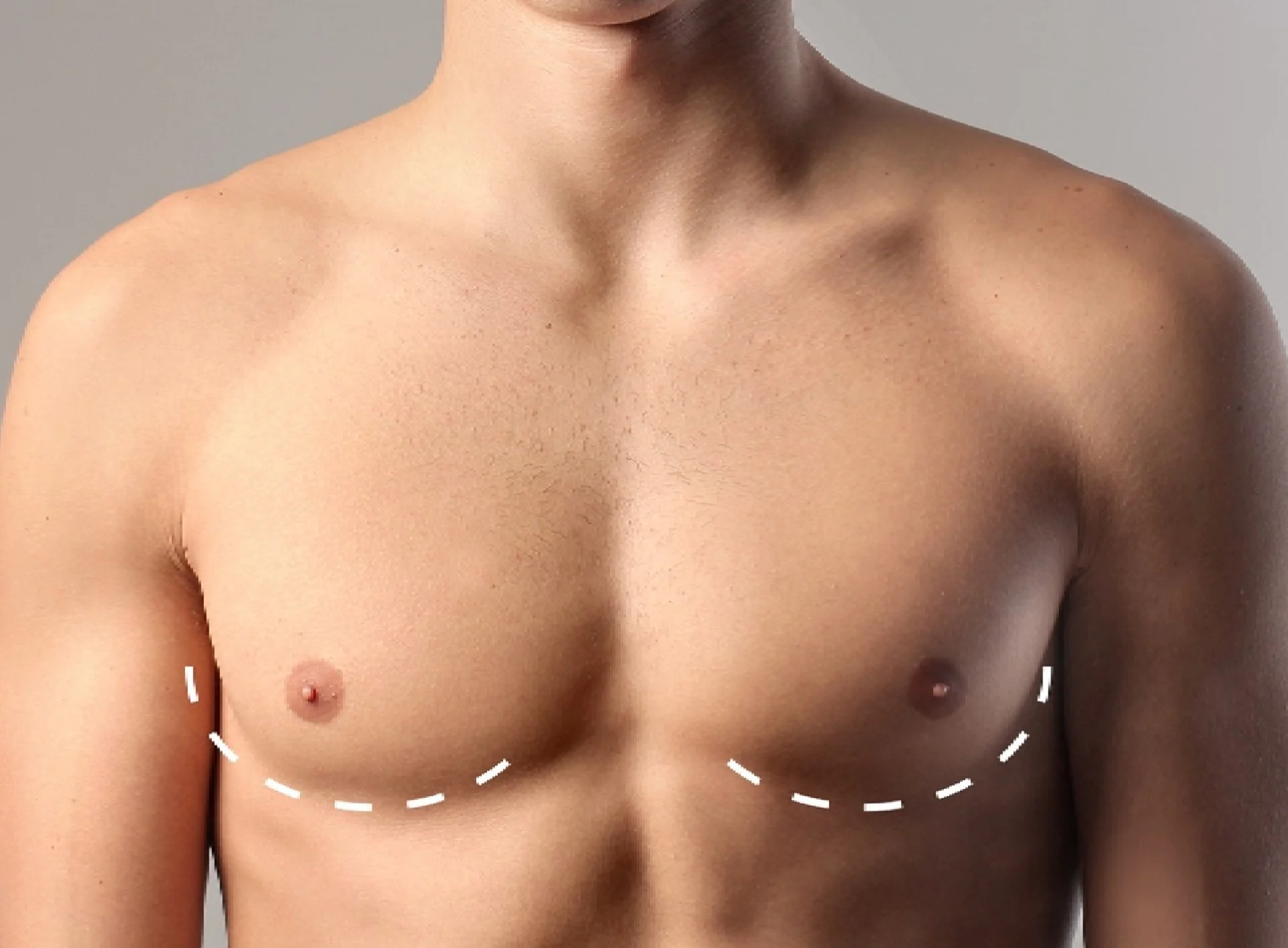 Achieving Natural Results with Gynecomastia in Dubai