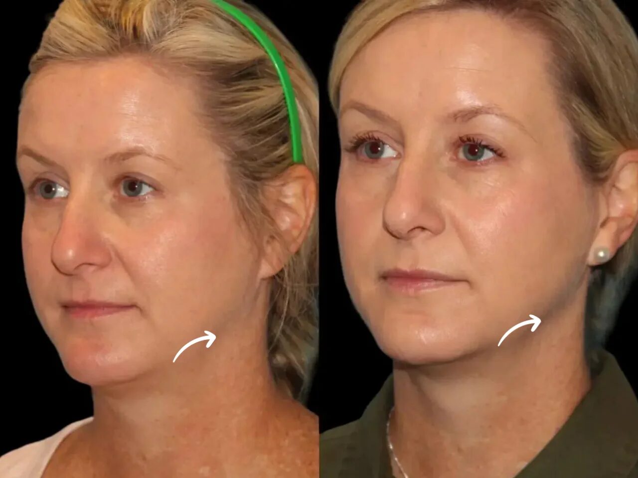 Why Best Doctors in dubai Recommend Sculptra for Facial Rejuvenation