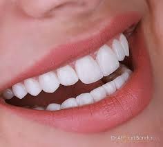 Veneers Dubai: The Key to a Perfect Smile