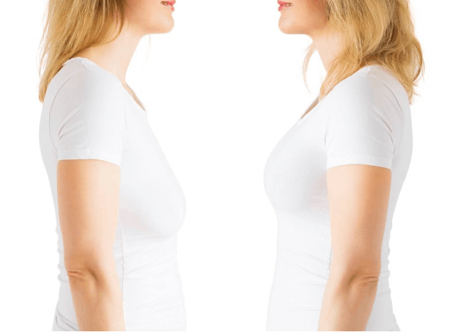 Breast Lift in Dubai: Frequently Asked Questions