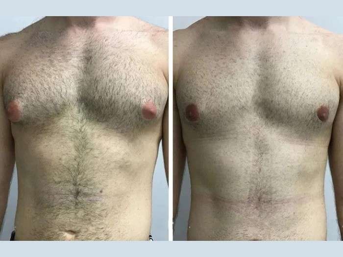 Gynecomastia in Dubai: Natural Remedies vs. Surgical Solutions