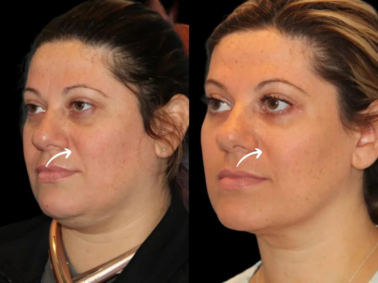 Is Sculptra Fillers in Dubai the Right Anti-Aging Solution for You?